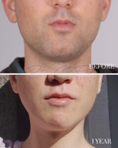 A before-and-after comparison image showing the lower face of a male patient. The top photo, labeled 'BEFORE,' depicts the patient's original appearance with a less defined upper lip and chin area. The bottom photo, labeled '1 YEAR,' displays the results one year post-procedure, featuring enhanced lip definition and a more sculpted chin and jawline.
