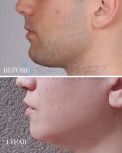 A before-and-after comparison image showing the side profile of a person's lower face and neck. The top part, labeled 'BEFORE,' depicts the presence of facial hair, acne, and less defined jawline. The bottom part, labeled '1 YEAR,' shows a smoother, clearer, and more refined skin appearance, indicating the results of a cosmetic or surgical procedure. The logo and text 'Dr. MFO Art, Surgery & Beauty' are visible in the center.