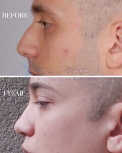 A before-and-after comparison image showing the side profile of a person's face. The top photo, labeled 'BEFORE,' depicts the individual with a noticeable bump on the nose and some skin imperfections. The bottom photo, labeled '1 YEAR,' shows the same individual one year post-procedure with a smoother nose profile and improved skin appearance. The logo and text 'Dr. MFO Art, Surgery & Beauty' are visible in the bottom right corner.