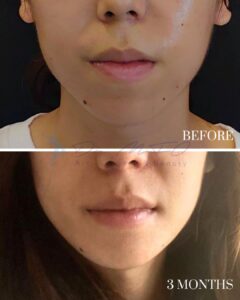 A before-and-after comparison image showing the lower face and chin area of an individual. The top photo, labeled 'BEFORE,' depicts the skin with visible acne and minor blemishes. The bottom photo, labeled '3 MONTHS,' shows significant improvement in skin clarity and smoothness, indicating the results of a skincare or cosmetic treatment over a three-month period.