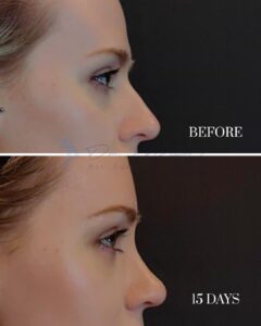A side-by-side comparison image showing the profile view of a person's nose before and 15 days after a cosmetic procedure. The 'BEFORE' image is at the top, and the '15 DAYS' post-procedure image is at the bottom, highlighting changes in the nasal structure.