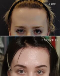 A before-and-after comparison image showing the forehead and eyebrows of an individual. The top photo, labeled 'BEFORE,' depicts sparse or missing eyebrows and a hairless forehead, likely due to alopecia or another condition. The bottom photo, labeled '3 MONTHS,' shows significant regrowth of eyebrows and fine hair on the forehead, indicating progress or recovery after three months.