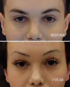 A before-and-after comparison image showing the eyes of an individual. The top photo, labeled 'BEFORE,' depicts drooping upper eyelids with sparse eyelashes. The bottom photo, labeled '1 YEAR,' displays the same individual with lifted upper eyelids, fuller eyelashes, and a more refreshed appearance, likely post-cosmetic procedure or treatment.