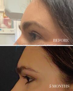 A before-and-after comparison image showing the eye and eyebrow area of a person. The top photo, labeled 'BEFORE,' depicts drooping or uneven upper eyelids. The bottom photo, labeled '5 MONTHS,' shows the same area post-procedure, with significant improvement in eyelid symmetry and appearance, indicating the results of a cosmetic or reconstructive surgery.