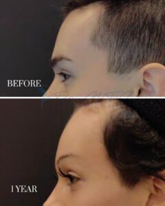 Forehead Contouring