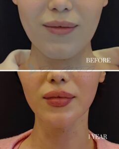 Jaw Reduction