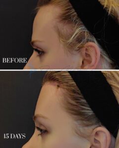 A side-by-side comparison image showing the before and after results of a cosmetic procedure on the ear area. The top photo, labeled 'BEFORE,' depicts the side profile of a person's ear with noticeable protrusion. The bottom photo, labeled '15 DAYS,' shows the same side profile 15 days post-procedure, with the ear appearing closer to the head and less prominent.