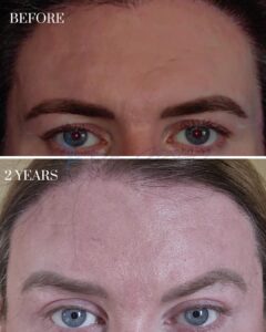 A before-and-after comparison image showing the forehead and eye area of an individual. The top photo, labeled 'BEFORE,' depicts visible wrinkles on the forehead and signs of aging around the eyes. The bottom photo, labeled '2 YEARS,' shows a smoother forehead with reduced wrinkles and a more youthful appearance around the eyes, indicating the results of a cosmetic or medical procedure over a two-year period.