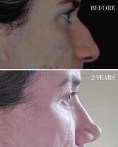 A side-by-side comparison image showing the profile view of a person's nose before and two years after a cosmetic procedure. The top section is labeled 'BEFORE,' depicting the original nasal structure, while the bottom section is labeled '2 YEARS,' showcasing the results of the procedure after a two-year period.