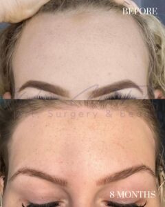 Forehead Reduction