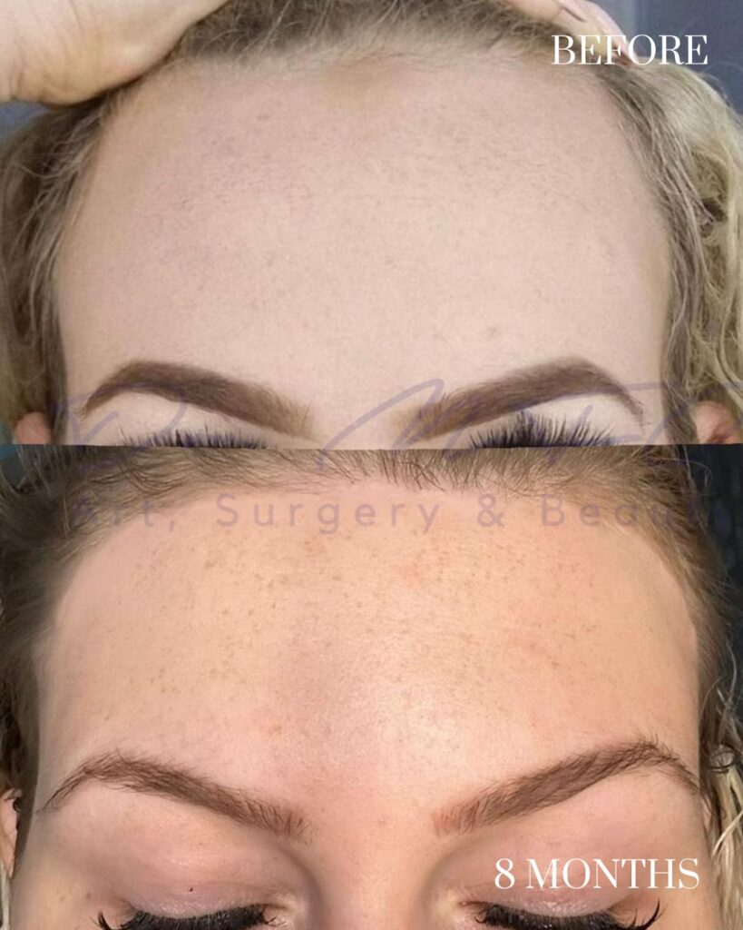 Forehead Reduction