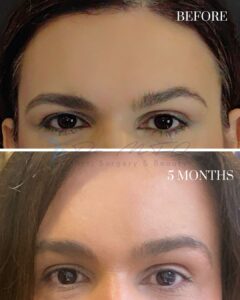 A before-and-after comparison image showing the results of an eyebrow procedure. The top photo, labeled 'BEFORE,' displays sparse and uneven eyebrows. The bottom photo, labeled '5 MONTHS,' shows fuller, more defined, and natural-looking eyebrows, indicating the progress and results achieved five months post-procedure.