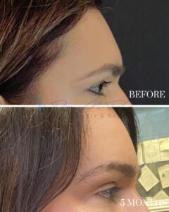 A before-and-after comparison image showing the side profile of an individual's eyebrow and eyelid area. The top image is labeled 'BEFORE,' depicting sparse or thin eyebrows. The bottom image is labeled '5 MONTHS,' showing noticeable improvement in eyebrow fullness and definition after a treatment or procedure.