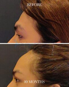 A before-and-after comparison image showing the side profile of a person's eyebrow and hairline area. The top part is labeled 'BEFORE,' depicting sparse or thinning eyebrows and a lower hairline. The bottom part is labeled '10 MONTHS,' showing improved eyebrow density and a higher, more defined hairline, likely indicating the results of a cosmetic or medical procedure.