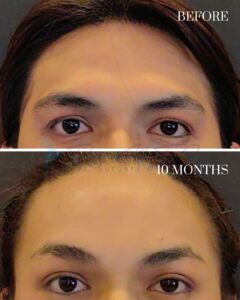 A before-and-after comparison image showing the results of an eyelid or eyebrow procedure. The top photo, labeled 'BEFORE,' depicts a person with slightly drooping upper eyelids. The bottom photo, labeled '10 MONTHS,' shows the same person with a more lifted and symmetrical appearance of the upper eyelids and eyebrows, indicating the results 10 months post-procedure.