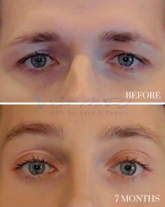 A before-and-after comparison image showing the eyes of an individual before a cosmetic procedure and seven months post-procedure. The top part of the image is labeled 'BEFORE,' depicting drooping upper eyelids, while the bottom part is labeled '7 MONTHS,' showcasing more lifted and refreshed eyelids and a more alert appearance.
