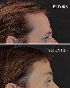 A before-and-after comparison image showing the side profile of a person's hairline and eyebrow area. The top part is labeled 'BEFORE,' depicting a higher hairline with sparse hair. The bottom part is labeled '7 MONTHS,' displaying noticeable hair growth and a fuller hairline after the 7-month period.