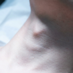A high-resolution, clinical close-up shot of a human neck, likely captured with a 100mm macro lens for extreme detail. The image exhibits hyper-realistic clarity, emphasizing the skin's natural texture and subtle physiological landmarks. The lighting is soft and diffused, characteristic of a medical or clinical setting, casting gentle shadows that define the contours of the throat and jawline. The focus is sharp on a localized, slightly raised tissue area on the neck, highlighting the skin's pores and natural luminescence. The subject is captured in a neutral, supine position, suggesting a medical examination or aesthetic procedure context. The background is composed of sterile, draped fabric, reinforcing the clinical atmosphere. No clothing or jewelry is present; the focus remains entirely on the anatomical study of the skin and underlying structure.