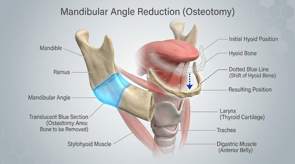 A highly detailed, 8K clinical medical illustration depicting the anatomical procedure of Mandibular Angle Reduction (Osteotomy). The composition is rendered with hyper-realistic precision, utilizing clean, clinical studio lighting to emphasize the skeletal structure and associated musculature. The focus is on the mandible, where a translucent blue section highlights the specific osteotomy area targeted for bone removal. The imagery clearly delineates the hyoid bone, its initial and resulting shifted positions, the larynx (thyroid cartilage), trachea, and key muscles such as the stylohyoid and digastric. Set against a sterile, professional medical background with a subtle hexagonal pattern, the illustration conveys absolute clarity and surgical precision, devoid of human fashion elements or organic skin textures, focusing entirely on anatomical accuracy and educational clarity.
