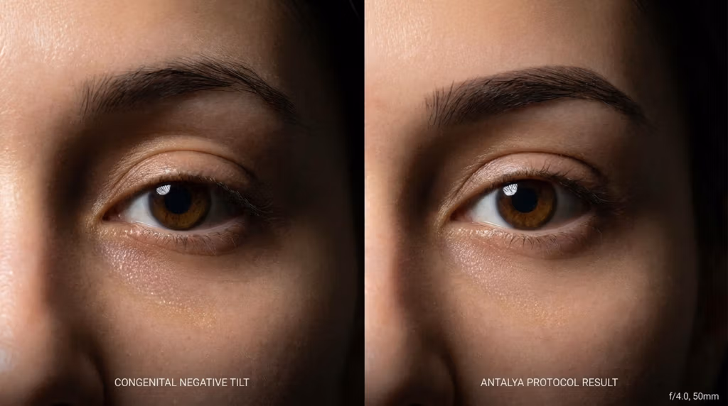 Fotografia comparativa medico-estetica a schermo diviso, scattata con un obiettivo da 50 mm a f/4.0, che offre dettagli iperrealistici con risoluzione 8k. L'immagine presenta un primo piano clinico della zona oculare femminile, focalizzandosi sull'inclinazione cantale e sulla regione periorbitale. L'illuminazione è caratterizzata da una luce direzionale morbida e precisa che delinea la struttura anatomica, evidenziando le sottili transizioni della pelle. La texture cutanea è riprodotta con fedeltà clinica, mostrando pori naturali, una delicata luminescenza e variazioni realistiche del tono della pelle senza ritocchi eccessivi. Il pannello di sinistra, etichettato "INCLINAZIONE NEGATIVA CONGENITA", contrasta con il pannello di destra, etichettato "RISULTATO DEL PROTOCOLLO ANTALYA", che mostra un allineamento cantale corretto, da neutro a positivo. La composizione è minimalista e professionale, su uno sfondo scuro e neutro che enfatizza l'anatomia oculare e il risultato ricostruttivo e raffinato della procedura.