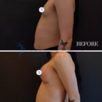 A split-screen medical comparison photograph documenting a surgical breast augmentation. The top frame, labeled 'BEFORE', displays the lateral profile of a person with a flatter chest contour against a stark black background. The bottom frame, labeled '2 WEEKS', shows the post-operative result with enhanced breast projection and visible surgical incision lines beneath the inframammary fold. The photography utilizes clinical lighting that emphasizes anatomical structure, soft tissue definition, and skin tone. The subject has a butterfly tattoo on the forearm. The composition is clean, standardized, and high-resolution, characteristic of professional aesthetic surgical documentation intended to highlight volume restoration and morphological changes.