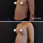 A clinical split-screen comparison photograph presented in high-definition DSLR quality, capturing a patient's surgical progress. The top panel ('BEFORE') and bottom panel ('2 WEEKS') utilize a standard 50mm-85mm focal length equivalent, typical for medical aesthetic documentation to ensure accurate anatomical representation without distortion. The lighting design is characterized by soft, diffused, clinical studio illumination coming from a frontal-lateral angle, designed to minimize harsh shadows while maintaining clear contrast to highlight the sculptural results of the breast augmentation. The anatomy depicts a female torso with a notable transition in chest contouring, showcasing enhanced projection and refined volume. Skin texture appears smooth with clinical hygiene, showing natural luminescence under controlled lighting. The '2 WEEKS' panel reveals the surgical incision line on the inframammary fold, emphasizing the precise placement of the implant. The patient is captured in a neutral, standing profile pose, wearing comfortable loungewear (gray joggers), contrasting with the minimalist, dark, monochromatic background. The composition is clean and professional, prioritized for medical clarity and patient transformation documentation.