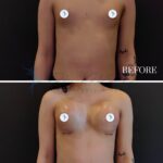 A clinical, before-and-after medical comparative photograph presented in a split-screen format, captured with high-resolution digital optics to ensure professional detail. The lighting is sterile and direct, typical of medical photography, designed to evenly illuminate the torso for objective analysis. The subject is a person shown in a frontal, neutral pose, highlighting anatomical changes in the chest area post-procedure. The skin texture appears smooth, with natural luminescence and visible post-surgical markers such as circular nipple covers and faint, healing incision lines visible at the infra-mammary folds in the '2 WEEKS' frame. The background is a stark, matte black surface, creating a clinical contrast that isolates the torso. The image serves as a clean, professional medical record, lacking accessories or clothing, focusing entirely on the surgical result.