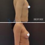 A split-screen clinical comparison photograph showcasing a lateral profile view of a patient before (top) and 1.5 years after a surgical procedure. Captured with the clinical precision of a DSLR camera, the high-resolution image utilizes a neutral, diffuse lighting setup to minimize harsh shadows and maintain consistent anatomical clarity. The subject stands in a natural, relaxed posture against a solid, matte dark grey background, typical of a medical facility setting. The focus is sharp, emphasizing the transformation of the chest contour, with the skin appearing clean, matte, and uniform. The image is strictly informative and clinical in nature, devoid of artistic textures or stylized apparel, serving as a clean, professional documentation of surgical results. Text overlays "BEFORE" and "1.5 YEARS" provide essential temporal context, and circular digital icons are superimposed over the pectoral area for privacy.