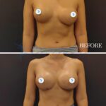 This clinical split-screen comparison, rendered with high-fidelity DSLR photography, displays a female subject's torso before and 14 days post-augmentation. Captured with a high-resolution lens optimized for medical documentation, the image maintains sharp focus on the anatomy. The lighting is clinical and uniform, utilizing flat-lighting techniques to eliminate distracting shadows and provide an objective, high-contrast view of the surgical results. The subject’s posture is neutral and upright, showcasing a toned, athletic build with a defined, lean midsection. The skin texture appears natural, with a subtle, healthy luminescence. The surgical area on the lower breast contour is visible with clinical precision, indicating a clean, professional recovery process. The composition is structured as a clear, instructional comparative layout against a matte, dark grey professional backdrop, emphasizing the anatomical transition with clarity and scientific focus. A delicate, minimalist gold chain adorns the subject’s neck, contrasting against the utilitarian waffle-knit fabric of the lower garment.