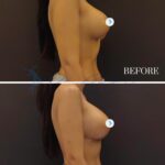 A side-by-side clinical aesthetic comparison captured in high-resolution DSLR photography, showcasing a female patient before and 14 days after a breast augmentation procedure. The lighting is soft and clinical, evenly illuminating the silhouette to emphasize the improved volume and natural contours of the bust. The subject stands in a profile pose against a neutral, dark matte background, highlighting her toned midsection and athletic build. The focus is sharp, capturing the subtle skin texture and the healing surgical incision line in the post-procedure frame with medical precision. The subject wears casual, textured lounge bottoms, maintaining a clean, professional clinical aesthetic. The overall composition is minimalist and informative, typical of a plastic surgery portfolio, focusing on anatomical refinement and tissue post-operative recovery.