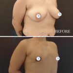 A high-resolution, clinical comparison photo showcasing a medical transformation. The composition features two stacked, waist-up frames of the same individual, labeled 'BEFORE' and '9 DAYS' post-operation. Captured with a professional DSLR and a sharp prime lens, the imagery maintains clean focus and consistent 4K clarity. The lighting is clinical and uniform, designed to minimize distracting shadows and clearly document anatomical changes following breast reduction surgery. The individual, seen in a neutral, hands-behind-the-back stance, exhibits clear post-surgical skin texture with faint, natural healing marks around the areolar regions. The backdrop is a seamless, neutral gray-brown, typical of a professional medical clinic, emphasizing the precision of the surgical outcome rather than artistic flair. The image serves as a clean, objective visual record of a reconstructive or aesthetic procedure.
