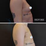 A medical editorial composite featuring a before-and-after comparison of a male patient’s torso profile. Captured with professional DSLR photography and a medium-telephoto lens, the image displays high-resolution clarity with crisp anatomical detail. The lighting is clinical and uniform, utilizing soft-box studio illumination from a side angle to subtly highlight the definition of the pectoral region, shoulder, and abdominal contours without harsh shadows. The subject is a male standing in a relaxed posture, showcasing a visible transformation in chest contour and definition seven days post-procedure. The skin texture is matte and natural, appearing clean and well-hydrated, reflecting the professional clinical setting. The composition is split horizontally by a white line, separating the 'BEFORE' and '7 DAYS' states against a minimalist, dark background that maintains focus on the patient's anatomy. Small, distinct tattoos are visible on the side of the torso, providing fixed reference points for the progression. The overall atmosphere is professional, clean, and evidence-based, characteristic of high-end cosmetic surgery documentation.