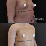 A clinical before-and-after comparison photograph showing a patient's torso, specifically focused on a chest contouring procedure. The top frame shows the pre-operative state, while the bottom frame shows the result seven days post-surgery. Captured with high-resolution digital photography, the images utilize soft, clinical studio lighting to maintain neutral tones and clear anatomical visibility, effectively highlighting the reduction in volume and improved contouring of the chest area. The subject is captured from a consistent, side-angle perspective against a plain, dark background, ensuring the focus remains exclusively on the surgical outcome. The skin texture appears natural, with visible details like tattoos and moles maintained, and blue circular markers indicate specific surgical points. The composition is clean and objective, styled for medical documentation and surgical portfolio presentation.