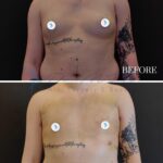 This clinical, high-resolution before-and-after comparison displays a post-operative medical documentation of a chest contouring procedure. Shot with a professional DSLR camera using a standard focal length lens (approx. 50mm) to ensure neutral, undistorted anatomical representation, the composition utilizes flat, clinical lighting to minimize shadows and accurately capture tissue changes. The subject is a person with a masculine-presenting torso, featuring a distinct black-ink floral tattoo on the left arm and a script tattoo across the ribcage. The skin texture is natural, showing characteristic post-surgical bruising and healing markers on the chest, common at the 7-day post-op milestone. The background is a stark, monochromatic dark studio backdrop designed to minimize distraction and prioritize the surgical results. There is no clothing present, emphasizing the clean, medical nature of the documentation, with circular privacy icons obscuring the nipple areas to maintain decorum. The overall aesthetic is strictly informative, professional, and devoid of artistic stylization, focusing purely on surgical outcome transparency.