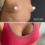 A split-screen medical comparison of a patient's chest before and 1.5 years after a breast augmentation procedure. The top frame shows a close-up, neutral-toned 'before' shot with natural contours. The bottom frame captures a professional, post-surgical result featuring a person wearing a vibrant, fuchsia-colored, high-performance athletic sports bra with a knit texture. The lighting is clinical yet clear, emphasizing the symmetry and enhanced volume of the breasts. The composition is focused on the medical outcome, presented with high-definition clarity that highlights the natural-looking contouring and skin texture, framed against a clean, neutral background typical of surgical portfolio documentation.