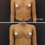 A high-resolution, clinical 'before and after' comparison photograph capturing a patient's torso transformation following cosmetic breast surgery. Captured with a professional-grade DSLR and a standard portrait lens, the image maintains high-fidelity clarity, showcasing clinical precision. The lighting is neutral and flat, typical of medical photography, ensuring consistent exposure across both panels to highlight anatomical changes. The subject is a female with an upright posture, photographed from the chest up against a plain, dark, non-distracting background. The focus is on the chest area, where skin texture displays natural post-surgical characteristics, including slight bruising and minor incision marks in the '2 weeks' panel. The subject is wearing casual garments—denim in the upper frame and a soft-textured top in the lower—providing a stark contrast to the medical focus. The composition is split horizontally with white text overlays denoting 'BEFORE' and '2 WEEKS', emphasizing the surgical recovery progression.