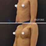 A professional clinical "before and after" medical photography composite, captured with a high-resolution 50mm lens typical of DSLR clinical documentation, delivering sharp, 4K-quality diagnostic imagery. The lighting is characterized by flat, clinical, front-facing strobe illumination designed to minimize harsh shadows and ensure accurate color rendering for medical assessment. The subject is a female patient positioned in a standard three-quarter profile to highlight thoracic and mammary contouring; the 'after' segment reveals post-operative recovery, showing surgically augmented breast tissue with visible incision lines and mild bruising near the axillary region, indicating a 2-week post-surgical timeline. The skin texture is neutral, matte, and free of artificial enhancements, reflecting the sterile nature of a clinical environment. The subject is wearing standard casual undergarments, with a simple, solid dark backdrop that focuses the viewer entirely on the surgical results. The composition is split horizontally by a crisp white line, with clear typographic markers denoting the temporal progression of the procedure.