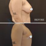This high-resolution clinical comparative photograph is captured with a high-fidelity DSLR, utilizing a 50mm lens to achieve a precise, distortion-free mid-shot. The lighting is crisp and even, utilizing a soft-box studio setup that minimizes harsh shadows while emphasizing surface topography and clinical clarity. The subject is presented in a profile view to highlight surgical outcomes, focusing on the refined contours and improved silhouette post-procedure. The skin texture is documented with sharp detail, reflecting a clean, medical-grade aesthetic without artificial sheen or moisture. The neutral, minimalist dark backdrop ensures the subject remains the focal point, creating a clean, professional medical editorial atmosphere that emphasizes procedural progress and anatomical transformation.
