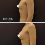 A clinical, professional side-by-side comparison photograph, presented in a high-resolution, medical-grade studio quality style, akin to DSLR photography with a clinical focus. The lighting is crisp, even, and diffuse, designed to eliminate distracting shadows while highlighting anatomical contours and surgical results. The subject is a female individual shown in profile, with a posture emphasizing the chest and torso. The skin texture is clear, natural, and matte, devoid of any artificial moisture or excessive sheen, presented with a clean, clinical aesthetic. The subject is partially unclothed, focusing on the torso to demonstrate the surgical transformation, with no clothing textures or hardware present. The composition is structured as a vertical diptych, split into 'BEFORE' (top) and '6 MONTHS' post-surgery (bottom) segments. The background is a stark, uniform dark charcoal matte, which enhances the subject's silhouette and ensures the focus remains entirely on the anatomical results. The overall atmosphere is clinical, objective, and illustrative, characteristic of medical aesthetics documentation.