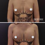 A professional medical before-and-after comparison shot captured with a high-resolution clinical DSLR camera using a standard 50mm lens. The composition is a split-screen layout presenting a torso transformation. The lighting is neutral, diffused clinical illumination that ensures consistent exposure across both panels, emphasizing the physiological changes in breast volume and contouring without harsh shadows or specular highlights. The subject is a female displaying a significant aesthetic enhancement in chest volume and symmetry at the two-week post-operative mark. Skin texture appears clear and natural, with slight surgical bruising visible on the upper chest area, documenting the authentic healing process. The focus is strictly clinical, set against a minimalist dark grey background, intentionally stripped of fashion-forward or editorial elements to maintain a focus on surgical precision and patient results. White modesty covers are placed on the areolas. The overall atmosphere is sterile, informative, and objective, suitable for a medical portfolio.