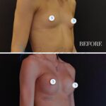 A clinical split-screen comparison, rendered in high-definition digital photography, showcasing a pre- and post-operative transformation of a female torso. The imagery is captured with high optical clarity, likely using a 50mm-85mm prime lens to maintain physiological accuracy while minimizing distortion. The lighting is characterized by controlled, clinical studio illumination—neutral and frontal to ensure anatomical transparency without artificial shadowing that would obscure the surgical result. The subject presents a slender, toned physique with visible clavicular definition. The post-operative frame, taken four days after the procedure, highlights the natural contours of the breast augmentation, with skin appearing smooth and undisturbed. The composition is straightforward and minimalist, set against a stark, non-distractive matte black backdrop, emphasizing the professional surgical outcome over stylistic artifice. Small, circular digital privacy overlays are applied to the breast areas. Overall, the aesthetic is clean, medical, and high-fidelity, designed to document clear anatomical change with precision.