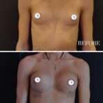A clinical comparison split-screen photography demonstrating a breast augmentation procedure result. The top panel ('BEFORE') and the bottom panel ('4 DAYS') are captured with high-resolution clinical precision, likely using a full-frame DSLR camera with a fixed focal length portrait lens (approximately 50mm-85mm) to minimize distortion. The lighting is functional and diffuse, characteristic of a professional medical studio setting, utilizing flat, front-facing illumination to eliminate harsh shadows and accurately document anatomical changes. The subject is a female with a slender frame, shown in a neutral, standing frontal pose. The 'BEFORE' image shows a natural, smaller chest profile, while the '4 DAYS' image highlights the immediate post-operative volume enhancement with visible surgical tape at the inframammary folds. The skin texture is clear and matte, without post-processing effects, focusing on the clarity of the surgical transition. The aesthetic is strictly clinical and informative, set against a dark, minimalist background that places the focus entirely on the anatomical comparison. A subtle silver chain with a cross pendant is visible in the '4 DAYS' panel, and white circular privacy covers are applied over the nipple areas in both frames. The image serves as a clean, high-clarity medical documentation of aesthetic surgery recovery.