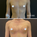 A clinical split-screen comparison of a patient's chest before and five days after a surgical procedure. Captured with high-fidelity DSLR photography, likely using a 50mm or 85mm prime lens to maintain realistic proportions and clinical clarity. The lighting is functional and diffuse, characteristic of a professional medical setting, designed to provide consistent, flat illumination that minimizes shadows and allows for an accurate assessment of the post-operative contours. The subject, a slender-framed individual, is positioned centrally against a sterile, neutral matte black backdrop. The 'Before' frame shows a flatter chest, while the '5 Days' frame captures the immediate post-surgical results, highlighting newly defined, lifted breast contours. The skin texture appears clean and slightly luminescent due to antiseptic application. In the top frame, a medical IV cannula is visible on the inner elbow, secured with surgical tape. The composition is strictly utilitarian and clinical, prioritizing the clarity of the anatomical transformation over aesthetic artifice, with small blue circular graphic overlays covering the nipples for privacy.