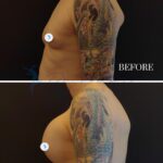 A clinical, side-by-side 'before and after' medical documentation photograph. The image features a shirtless individual from a profile view, highlighting a significant transformation in chest contour. Captured with the precision of high-resolution DSLR photography and a standard portrait lens, the composition utilizes flat, clinical lighting against a neutral black backdrop to ensure maximum focus on the anatomical change. The skin texture is documented in high fidelity, showing clear, natural surfaces devoid of sweat or artificial highlights. The focus is strictly on the surgical outcome, with no jewelry or garments present. The composition is split horizontally, clearly labeled 'BEFORE' and '1 WEEK' post-procedure, maintaining an objective, sterile atmosphere characteristic of professional medical aesthetic documentation.