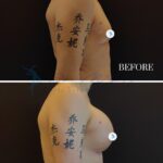 A side-by-side clinical 'before and after' medical photography composition, captured in 4K resolution with high-precision optical clarity reminiscent of a high-end DSLR setup. The top frame shows a patient's torso before a procedure, while the bottom frame shows the post-operative result at one week, demonstrating significant chest augmentation. The lighting is functional, high-key medical studio lighting that minimizes distracting shadows to ensure clear anatomical documentation, highlighting the skin's natural texture and the patient's prominent calligraphic arm tattoos. The subjects are presented against a neutral, dark background to prioritize the surgical outcome, with minimal skin surface interference, maintaining a professional, clinical, and objective editorial aesthetic.
