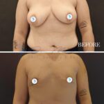 A clinical comparative photograph, displayed in a split-screen format, captures a female torso before and nine days after a breast surgery procedure. The imagery is executed with high-resolution, sharp DSLR photography, utilizing a standard portrait focal length to maintain anatomical accuracy. The lighting is functional, high-key studio illumination designed to minimize harsh shadows and provide even coverage, ensuring clear visualization of the surgical outcome and tissue healing. The composition is a centered, neutral-background clinical assessment, focusing on the changes in breast volume, contour, and skin tension. The texture of the skin is captured with high fidelity, showing natural skin tone and post-operative indicators such as subtle skin puckering around the nipple-areola complex, which is a common clinical feature in the early healing phase. The image serves as a professional medical documentation, conveying the precise physical evolution of the patient's anatomy while maintaining a clean, informative, and objective aesthetic appropriate for a surgical portfolio.