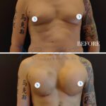 A high-resolution, clinical-grade medical comparison split-screen photography showcasing a patient's post-operative results. The upper frame ('BEFORE') and the lower frame ('1 WEEK') utilize a professional 50mm DSLR lens setup, capturing the torso in a neutral, forward-facing stance against a stark, non-reflective black backdrop. The lighting is characterized by flat, diffused studio-grade illumination, essential for accurate clinical documentation of anatomical changes, highlighting the surgical transition in chest volume and contour. The skin texture appears natural, showing standard post-surgical recovery markers such as subtle bruising and incision lines on the lower frame. The composition is strictly functional and centered, devoid of synthetic elements like moisture or fashion textiles, focusing instead on the clear, objective visualization of surgical outcome and aesthetic symmetry. The subject features distinct decorative ink art on both arms, providing a high-contrast visual anchor for the clinical documentation.