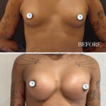 A clinical medical comparison split-screen photograph featuring a female patient before and three months after breast augmentation surgery. Captured with high-fidelity DSLR photography, likely using a 50mm or 85mm prime lens, the image displays sharp focus and professional-grade clarity. The studio lighting employs a neutral, flat light setup standard for medical documentation, minimizing dramatic shadows to accurately render anatomical contours and skin tone. The patient has a medium-to-deep skin tone and visible arm tattoos. The 'after' section highlights refined, symmetrical volume and natural-looking curvature, with skin exhibiting a healthy, hydrated texture and soft luminescence. There are no fabrics or jewelry; the focus is strictly on the anatomical results. The background is a plain, neutral-toned wall, maintaining a clinical, objective, and professional aesthetic.