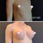A high-resolution, split-panel clinical photography composition comparing 'before' and '7 months post-operative' results of breast augmentation surgery. Captured with a high-fidelity DSLR lens, the imagery utilizes a clinical 50mm-85mm focal range that minimizes distortion, delivering crisp, 4K-level detail. The lighting is diffused, studio-quality soft-box illumination, positioned at a slight angle to create subtle highlights on the torso, effectively contouring the surgical outcome without harsh shadows. The subject is a female in a profile-three-quarter pose, showcasing the anatomical transformation with focus on the enhanced breast volume, projection, and the clean inframammary incision lines. The skin texture is rendered with authentic, pore-level clarity, maintaining natural luminosity. Set against a clean, matte, dark neutral backdrop, the composition is strictly medical-editorial in style, emphasizing aesthetic precision and structural symmetry through a clean, minimalist professional aesthetic. No clothing is present, allowing for an unobstructed view of the anatomical refinement.