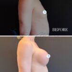 A clinical comparison 'before' and 'after' side-profile photograph showcasing breast augmentation results. The composition is a split-screen layout, captured with high-resolution DSLR photography using a standard portrait lens to minimize distortion. The lighting is clinical and uniform, utilizing soft-fill illumination to highlight anatomical changes, skin texture, and post-operative contouring without harsh shadows. The subject is a female positioned in a neutral, standing profile posture, emphasizing the change in silhouette and volume. The skin appears natural, with clear, non-reflective surfaces typical of a professional medical setting. The background is a solid, neutral tone that eliminates distractions, keeping the focus entirely on the physiological transformation. No clothing or jewelry is present, allowing for an unobstructed view of the surgical outcome. The 'before' panel presents a natural flat profile, while the '7 months' panel displays a lifted, enhanced profile with natural-looking curvature. The image is professional, aesthetic, and educational, serving as a clear documentation of cosmetic enhancement results.